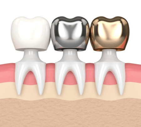 Dental Crowns: Purpose, Types, Procedure, Care, And Cost