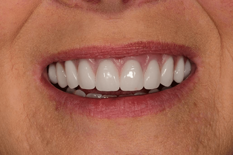 porcelain crowns after smiles gallery image