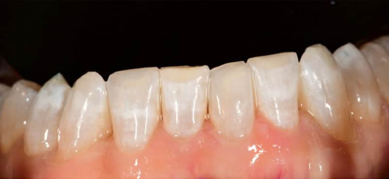 porcelain crowns after smiles gallery image