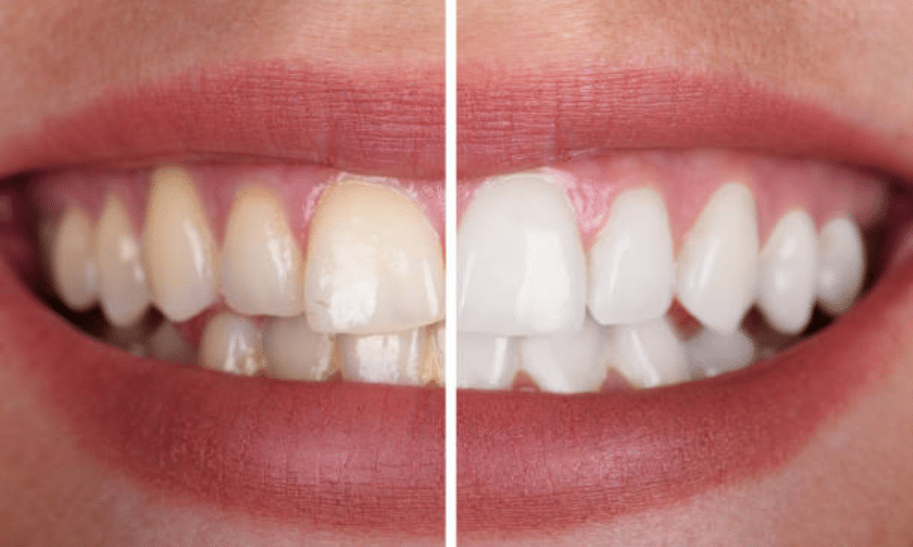 Get The Brightest Smile With Professional Teeth Whitening