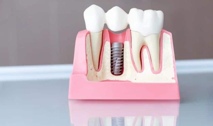 Is It Possible To Get Dental Implants In One Day?