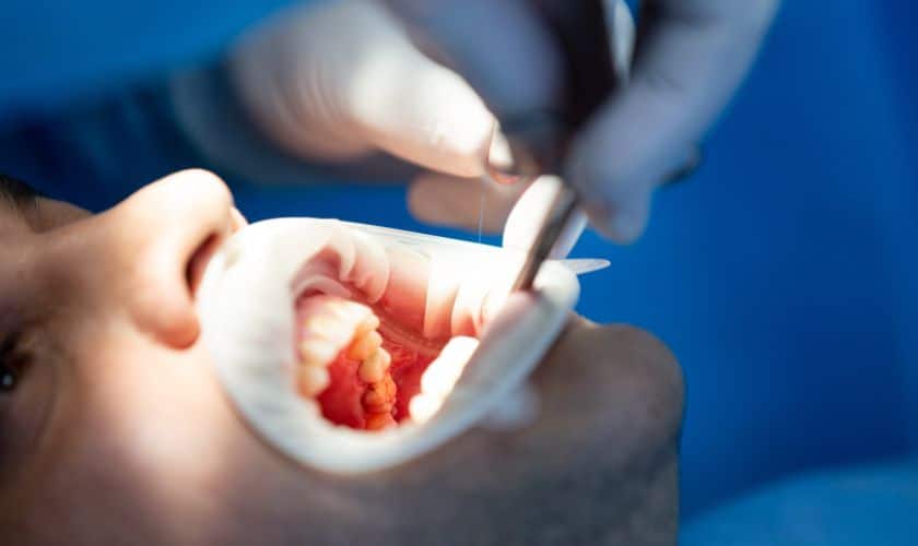 dental sealants in Phoenix, AZ