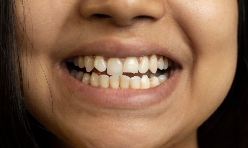 How to Fix a Broken Tooth at Home
