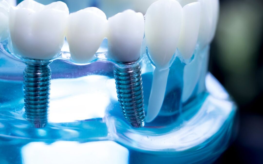 Can Smokers Get Dental Implants?