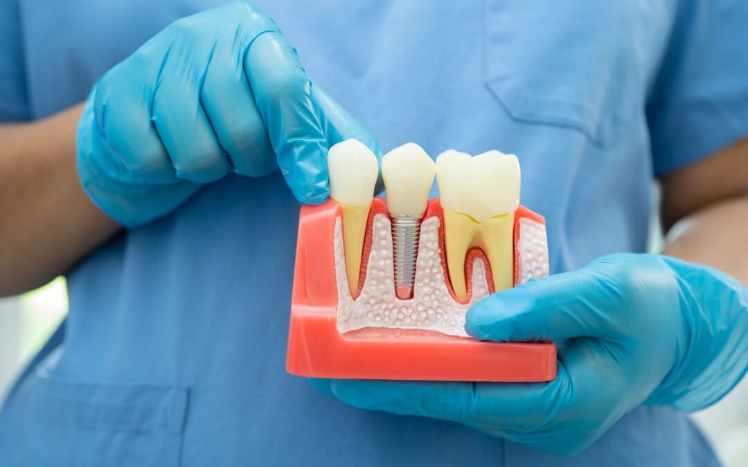 Am I Too Old for Dental Implants?