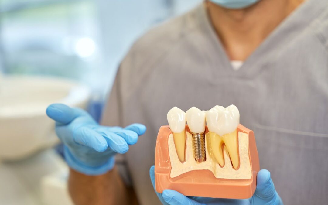 Frequently Asked Questions About Dental Implants