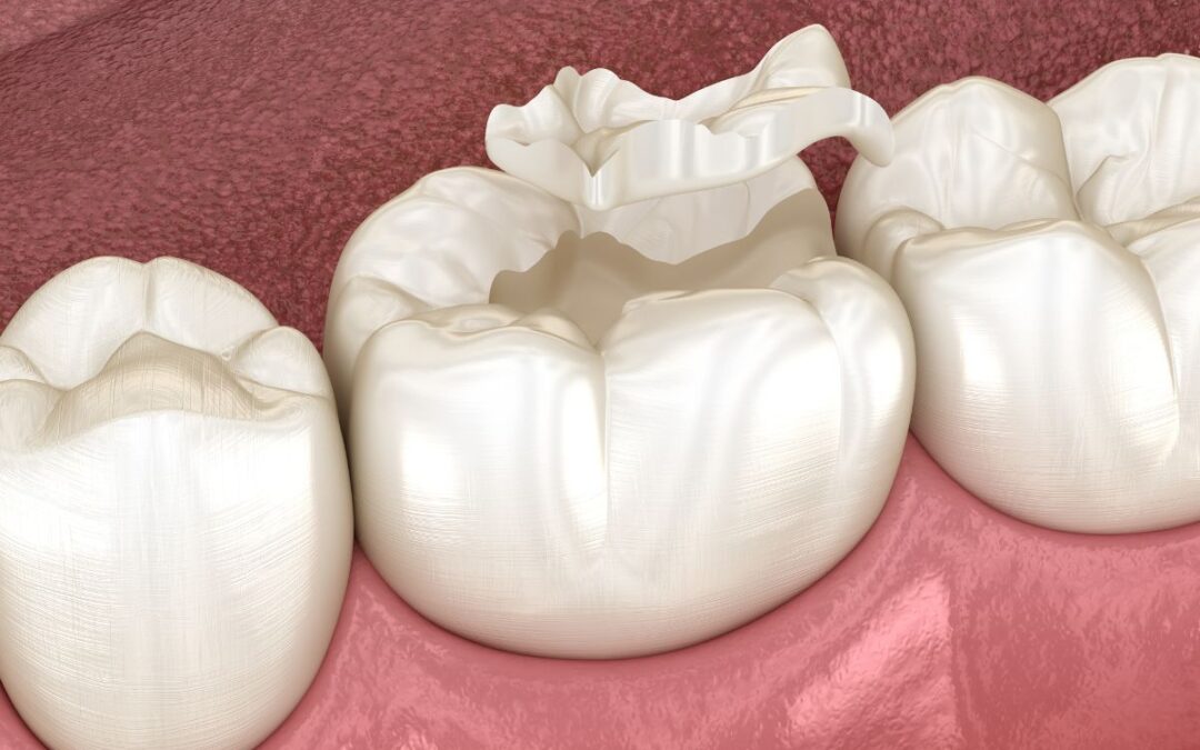 How to Repair a Cracked Tooth at Home