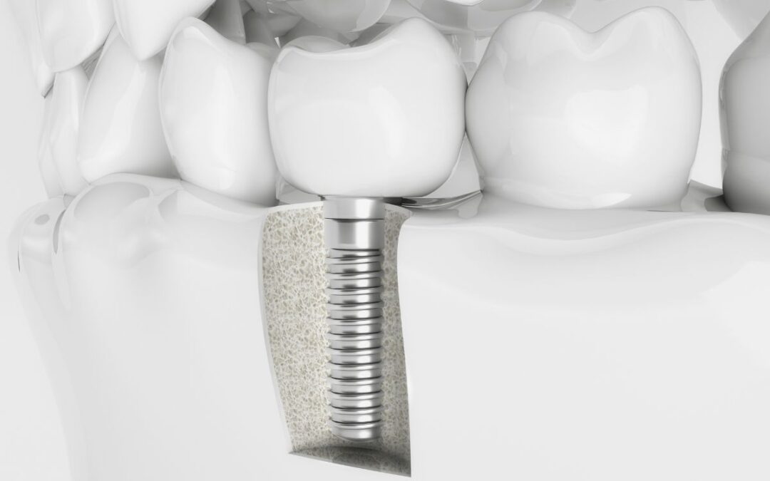 Can I Use Listerine After Receiving Dental Implants?