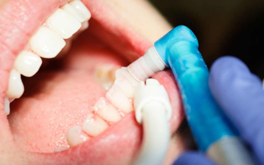 Sensitivity Shield: Cosmetic Bonding’s Soothing Solution