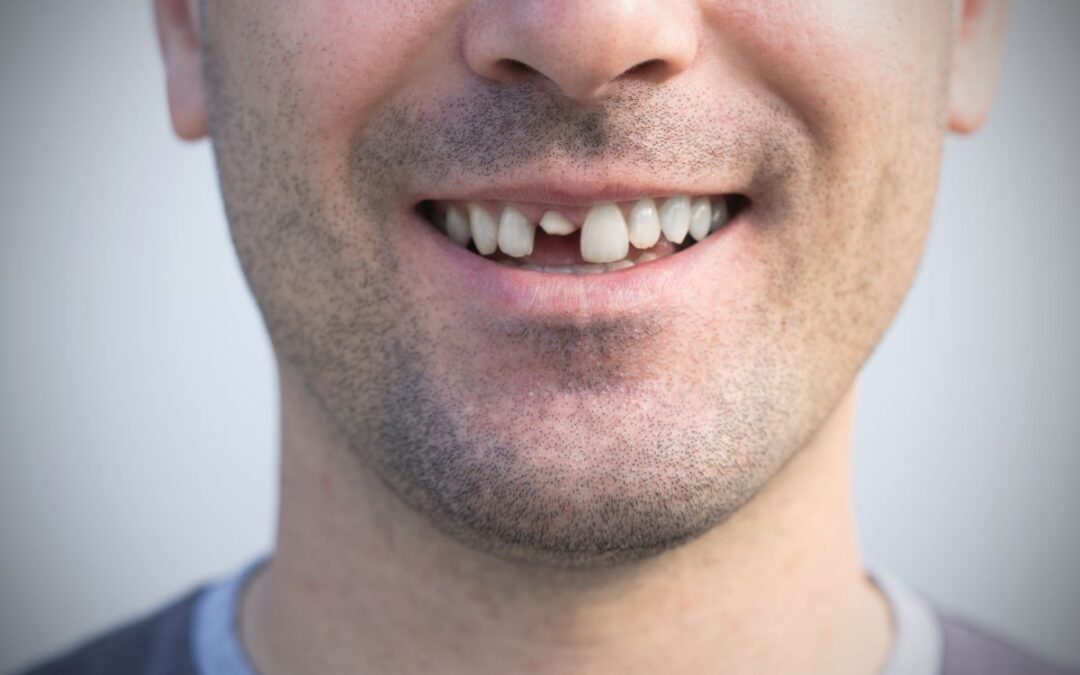 How Long Does It Take to Fix a Cracked Tooth?