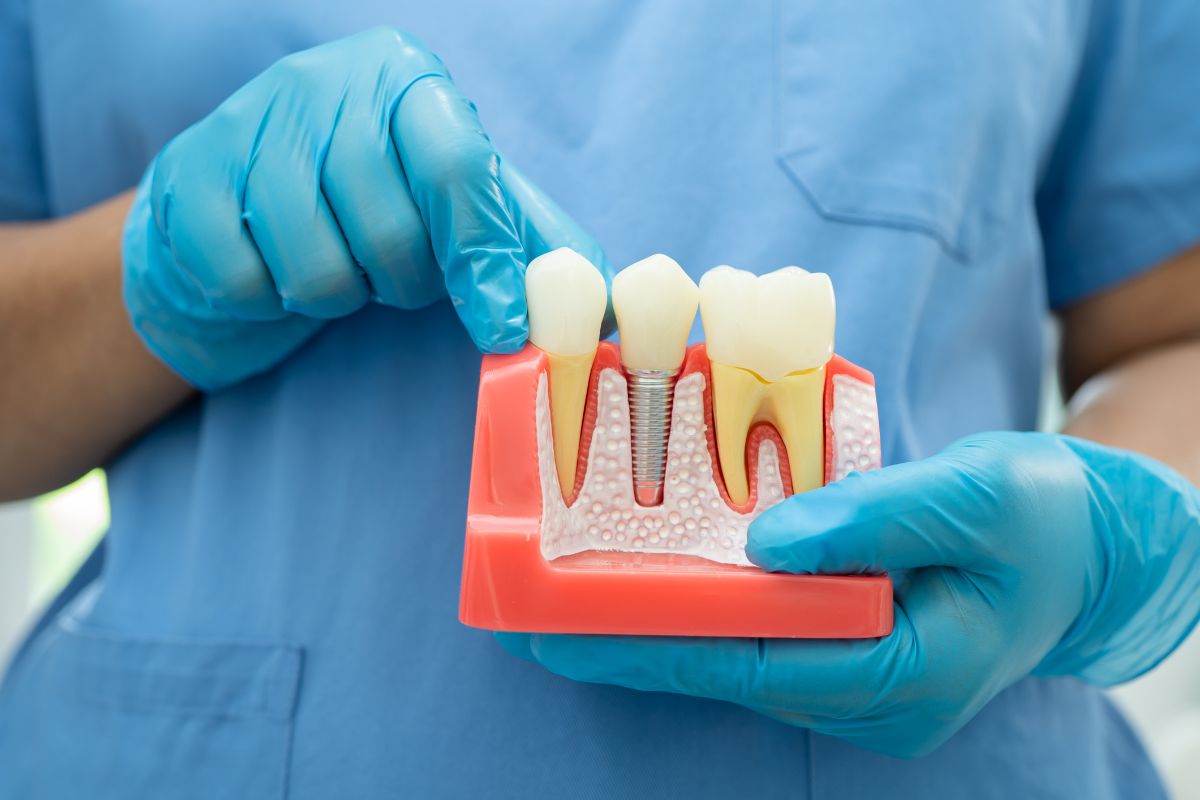 Can Dental Implants Affect My Taste dental implants in Phoenix