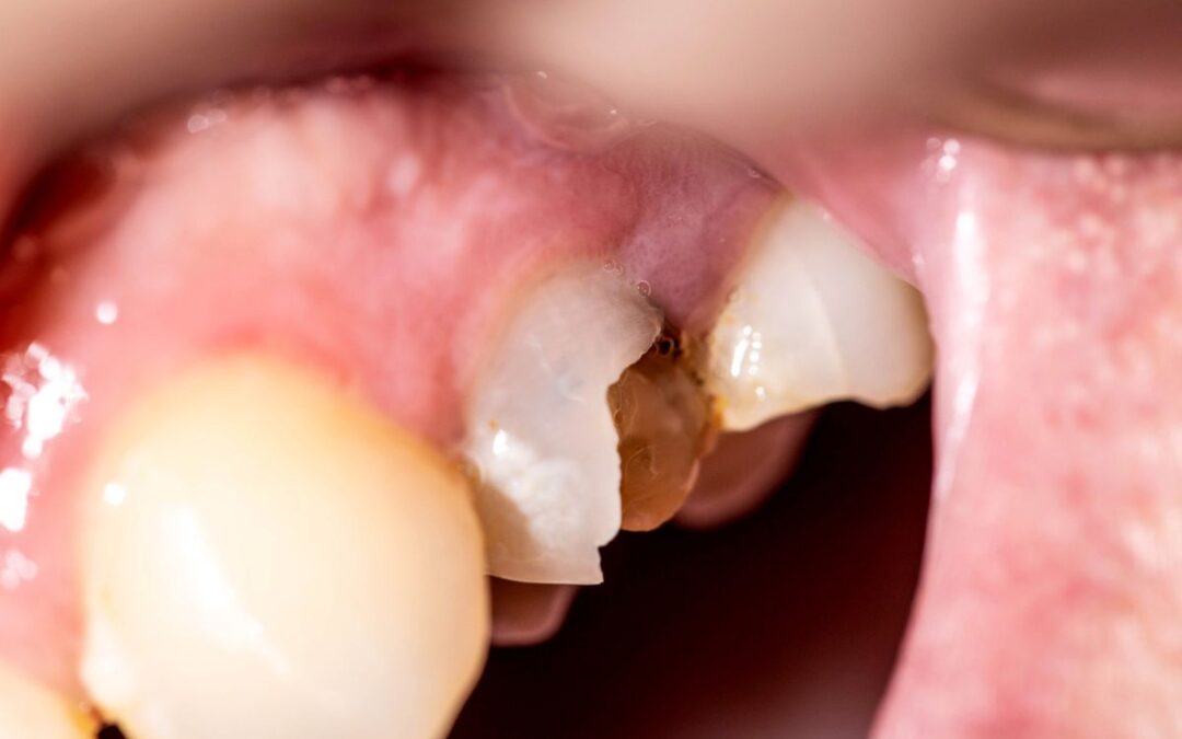 What Can Happen if You Don’t Get a Chipped Tooth Treated?