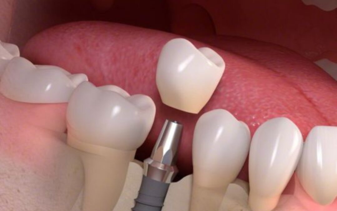 Mini Dental Implants vs. Traditional Implants: Which Is Better?