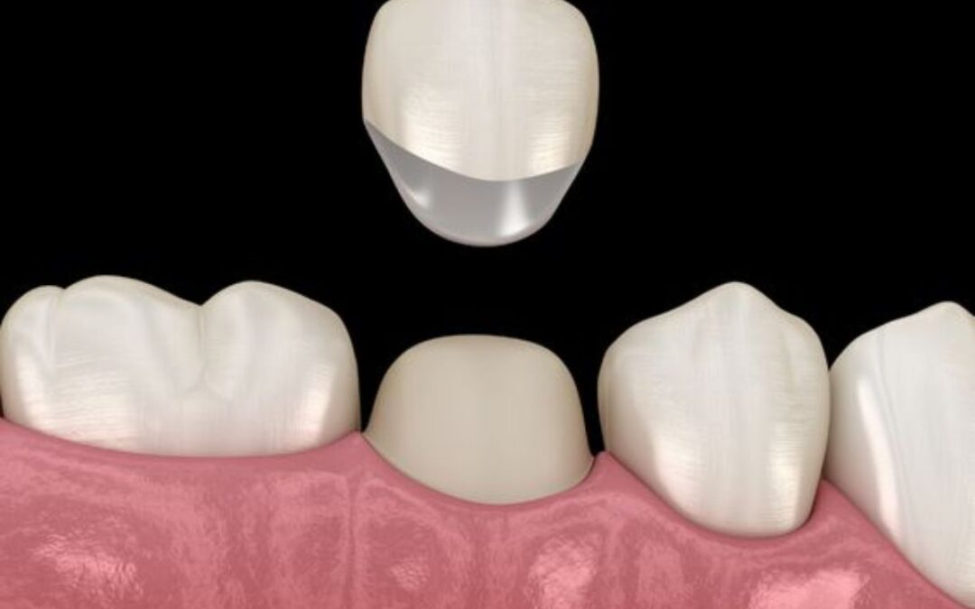 How Dental Crowns Can Restore Damaged Teeth and Improve Your Smile