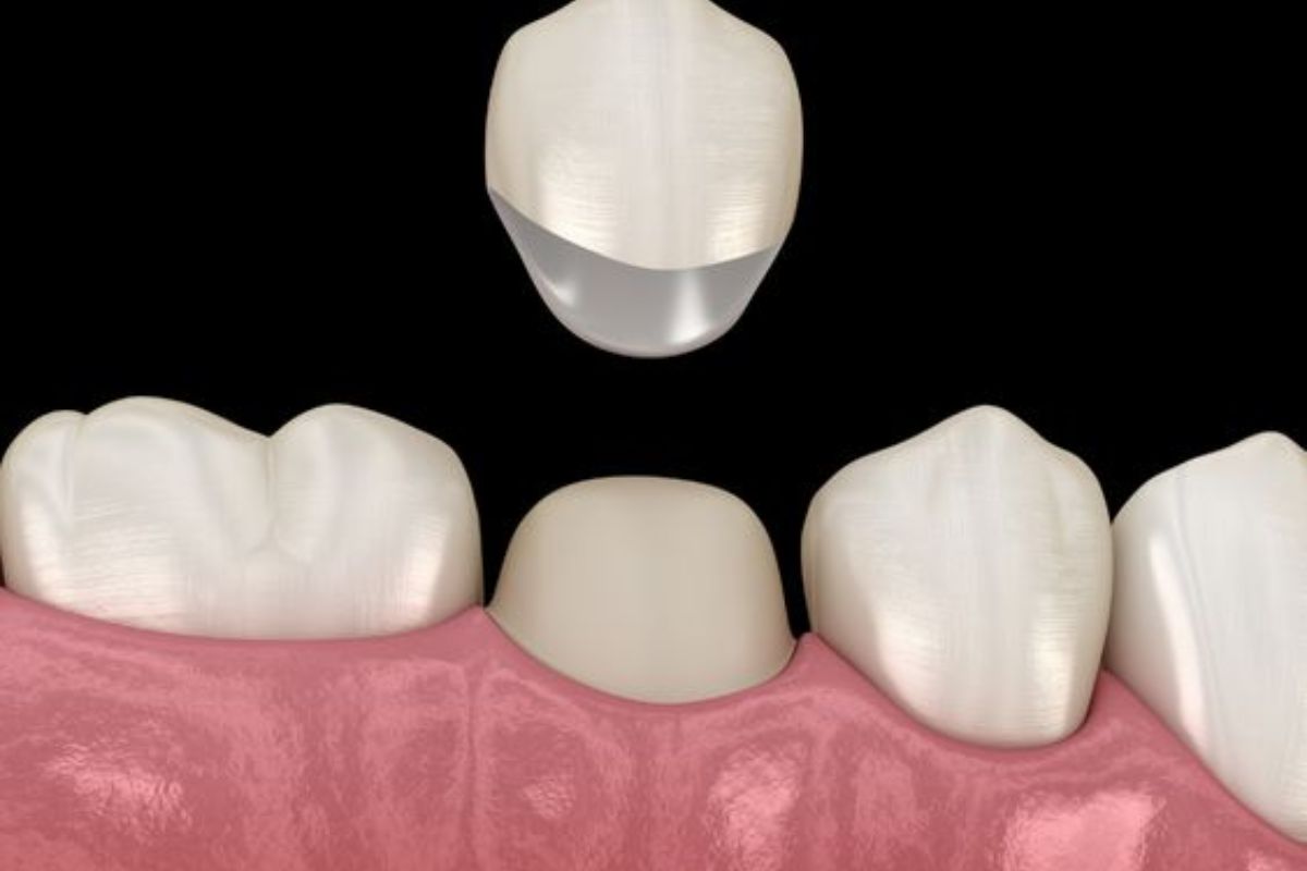 dental-crown