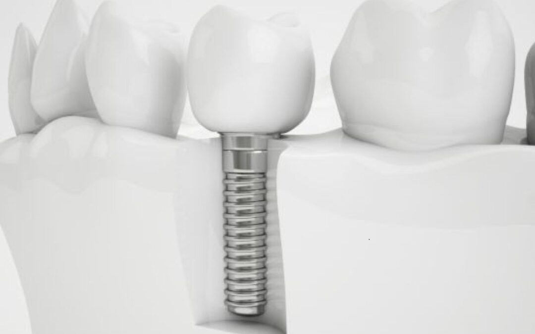 The Step-by-Step Process of Getting Dental Implants