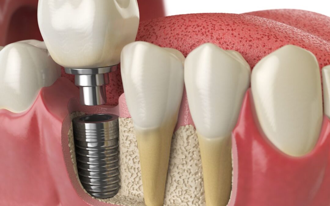 How Dental Implants Can Improve Your Oral Health