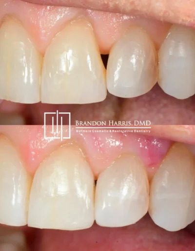 Before and After Cosmetic Bonding Procedure