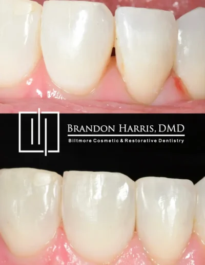 Before and After Cosmetic Bonding Procedure