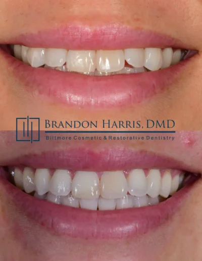 Before and After Invisalign Treatment
