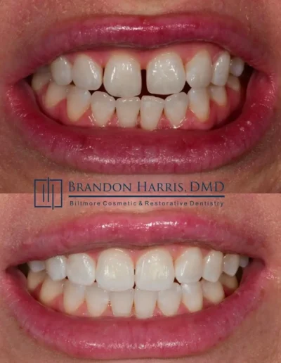 Before and After Invisalign Treatment