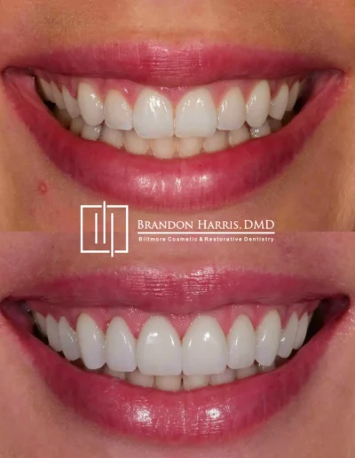 Before and After Dental Veneers Treatments
