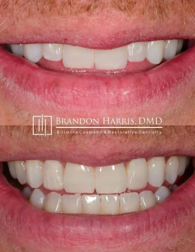 Before and After Dental Veneers Treatments