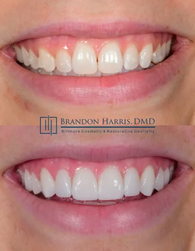 Before and After Dental Veneers Treatments