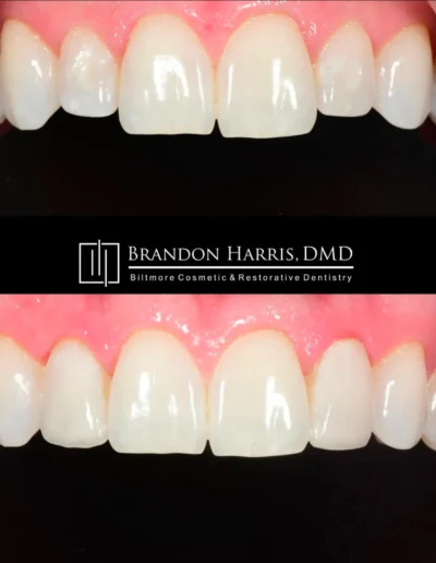 Before and After Dental Veneers Treatments