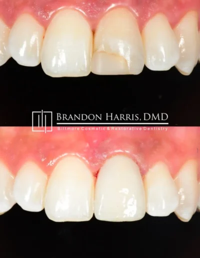 Before and After Dental Veneers Treatments