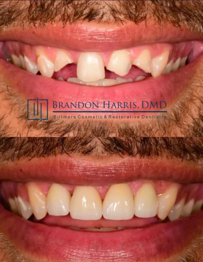 Before and After Dental Veneers Treatments