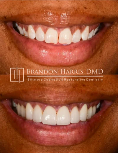 Before and After Dental Veneers Treatments