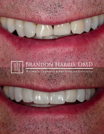 Before and After Dental Veneers Treatments