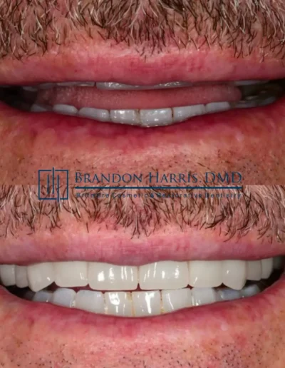 Before and After Dental Veneers Treatments