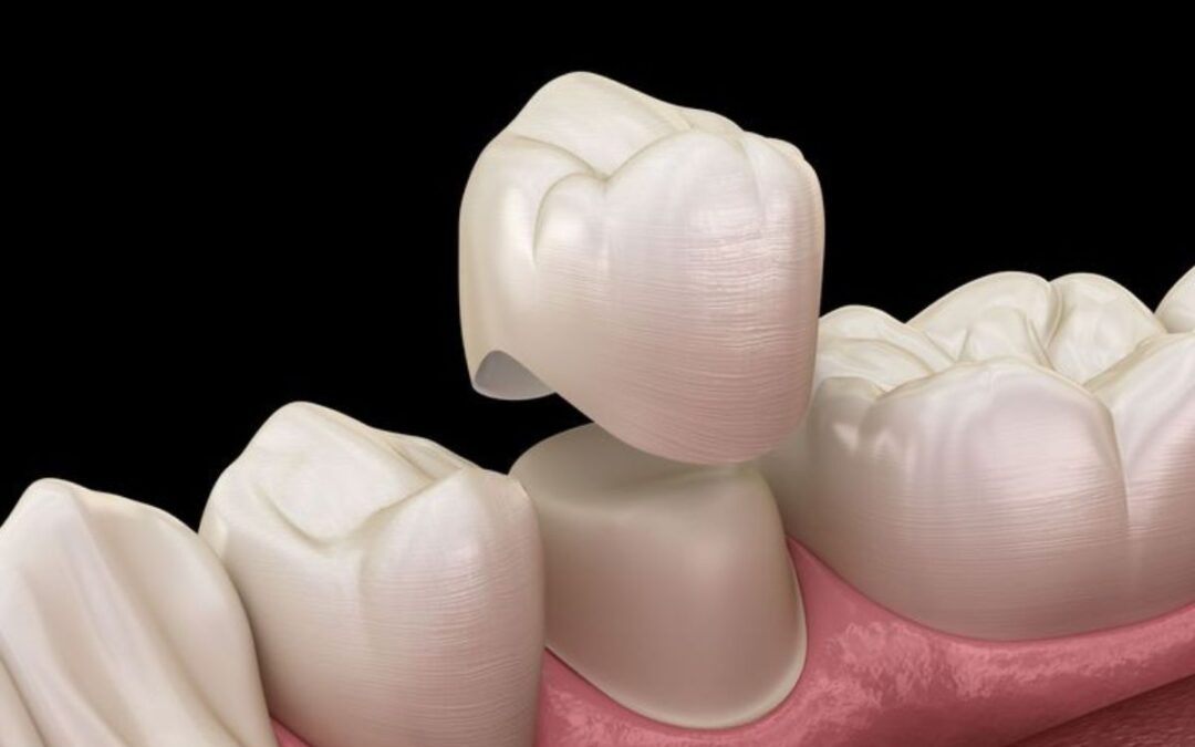 The Role of a Restorative Dentist in Rebuilding Your Smile