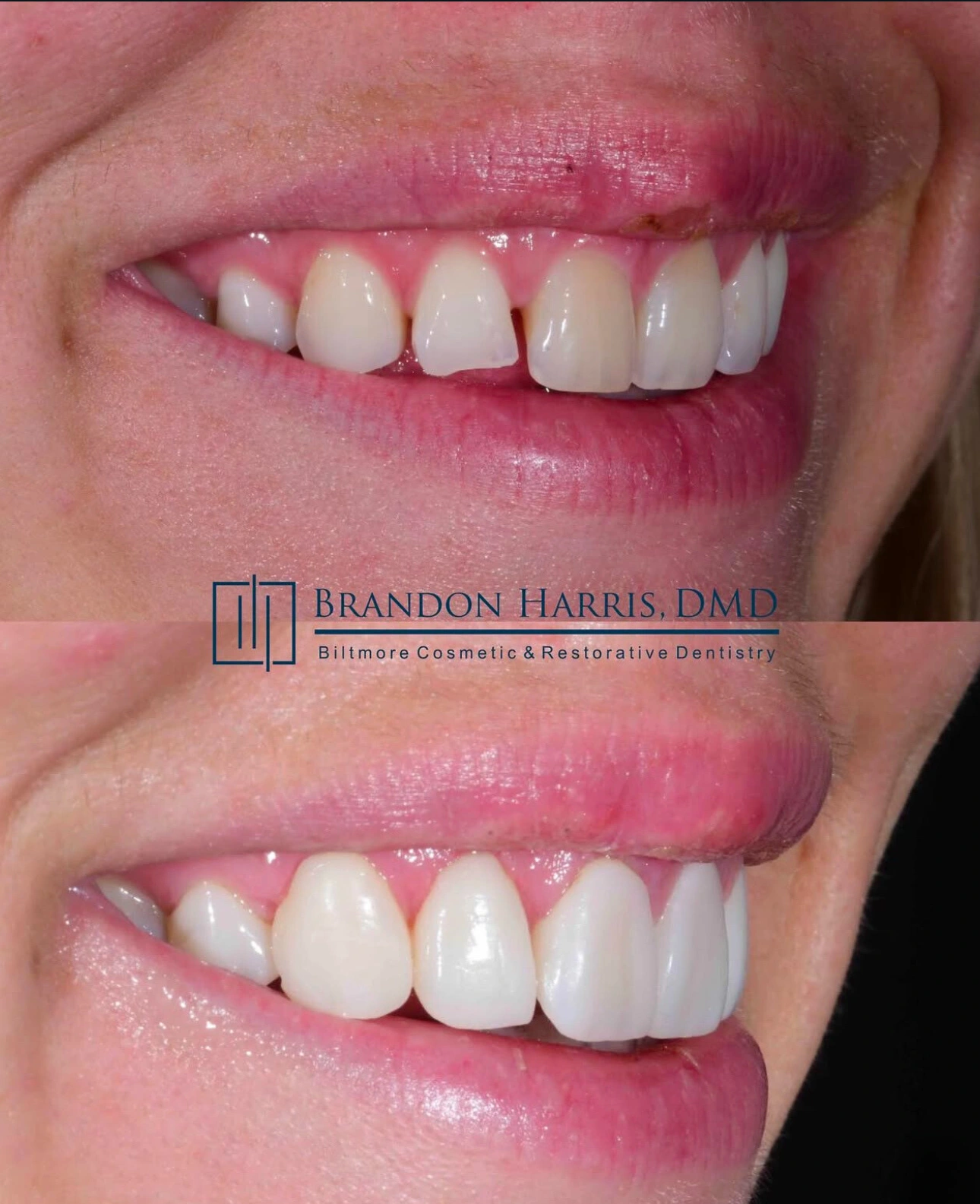 Cosmetic Bonding Phoenix