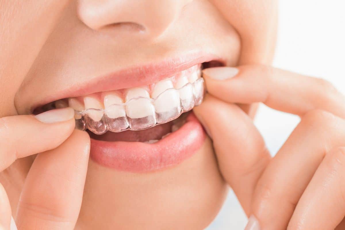 How Long Does It Take For Invisalign To Straighten Your Teeth Phoenix
