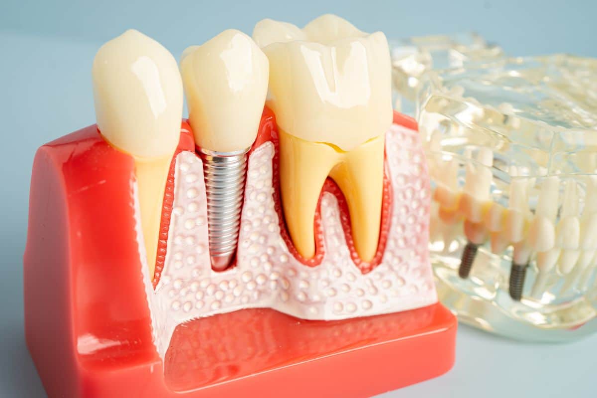 How Dental Implants in Phoenix Transform Your Smile