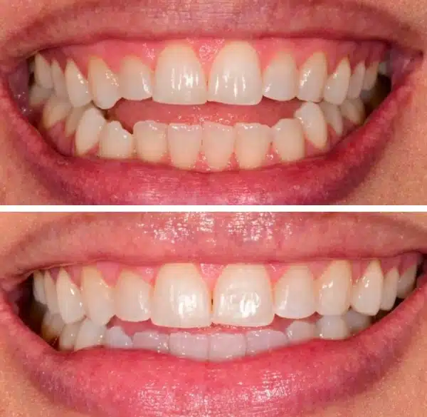 img-Invisalign-before-after1