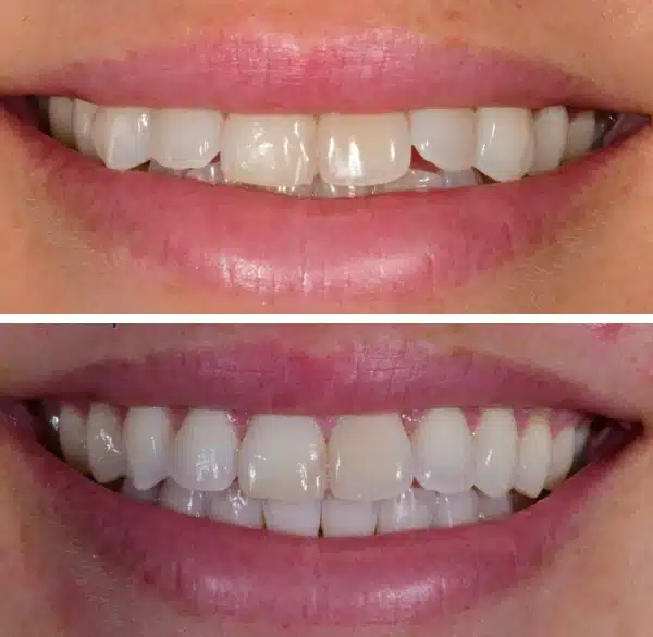 img-Invisalign-before-after10
