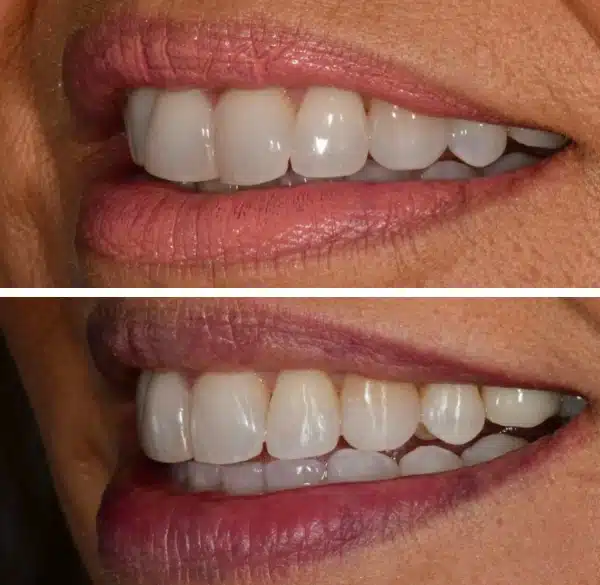 img-Invisalign-before-after2