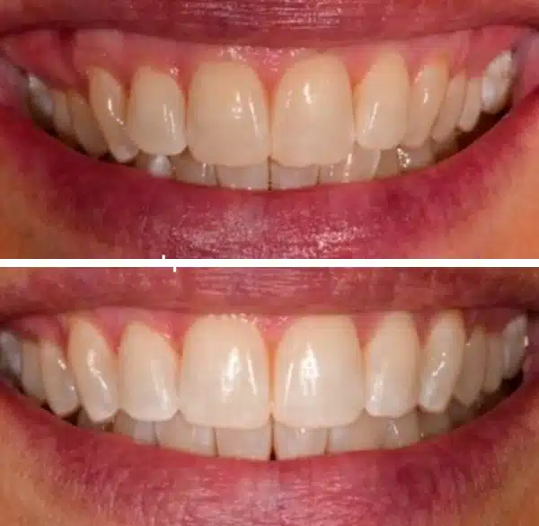 img-Invisalign-before-after3