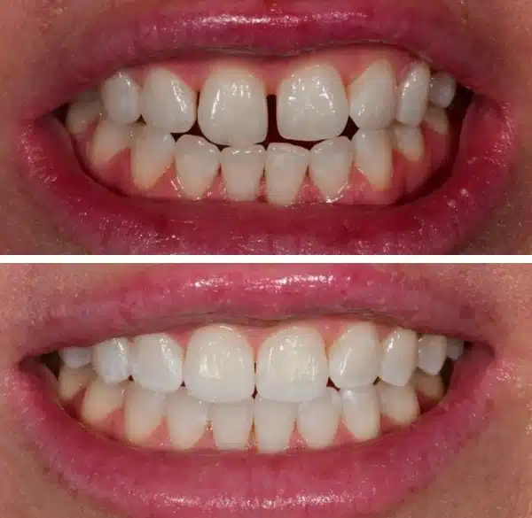 img-Invisalign-before-after4