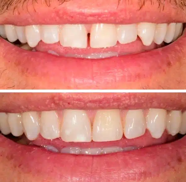 img-Invisalign-before-after5