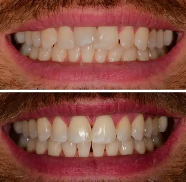 img-Invisalign-before-after6