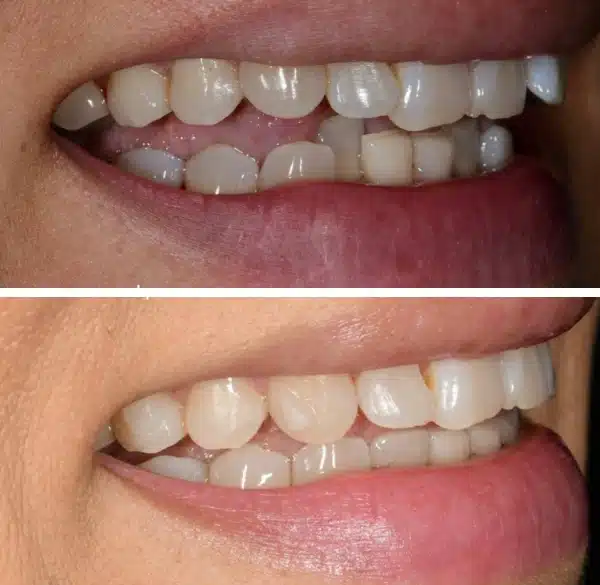 img-Invisalign-before-after7