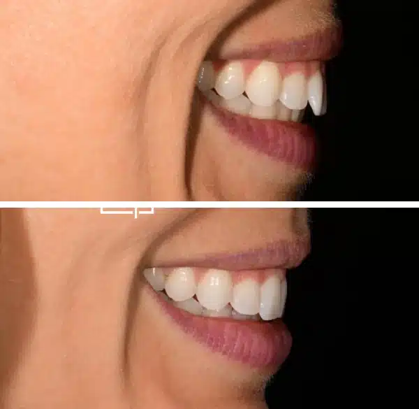 img-Invisalign-before-after8