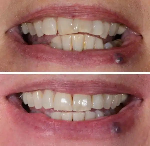 img-Invisalign-before-after9