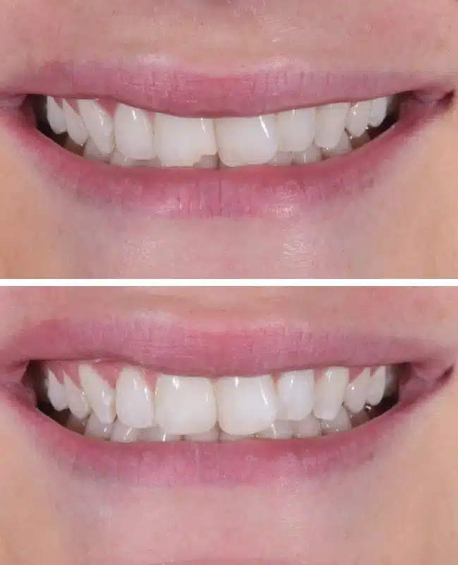 img-cosmetic-bonding-before-after-1