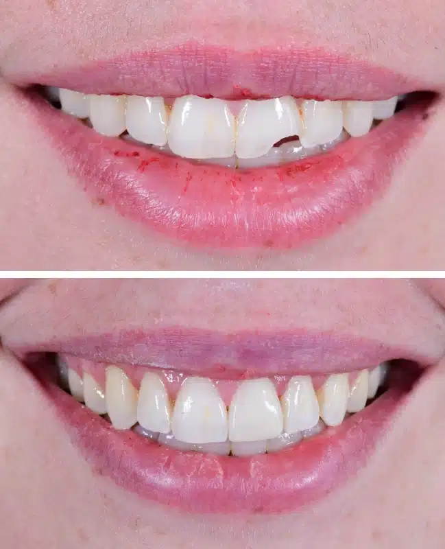 img-cosmetic-bonding-before-after-five